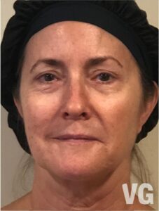 2a Photo Before with watermark Before Gua Sha