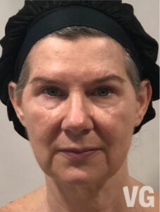 3a. Photo Before with watermark Before Gua Sha