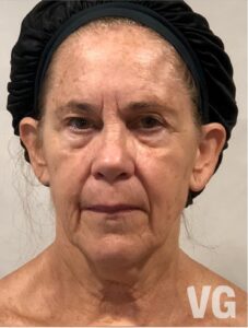 4a. Photo Before with watermark Before Gua Sha