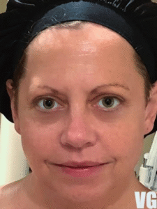 A7 After 1 Treatment